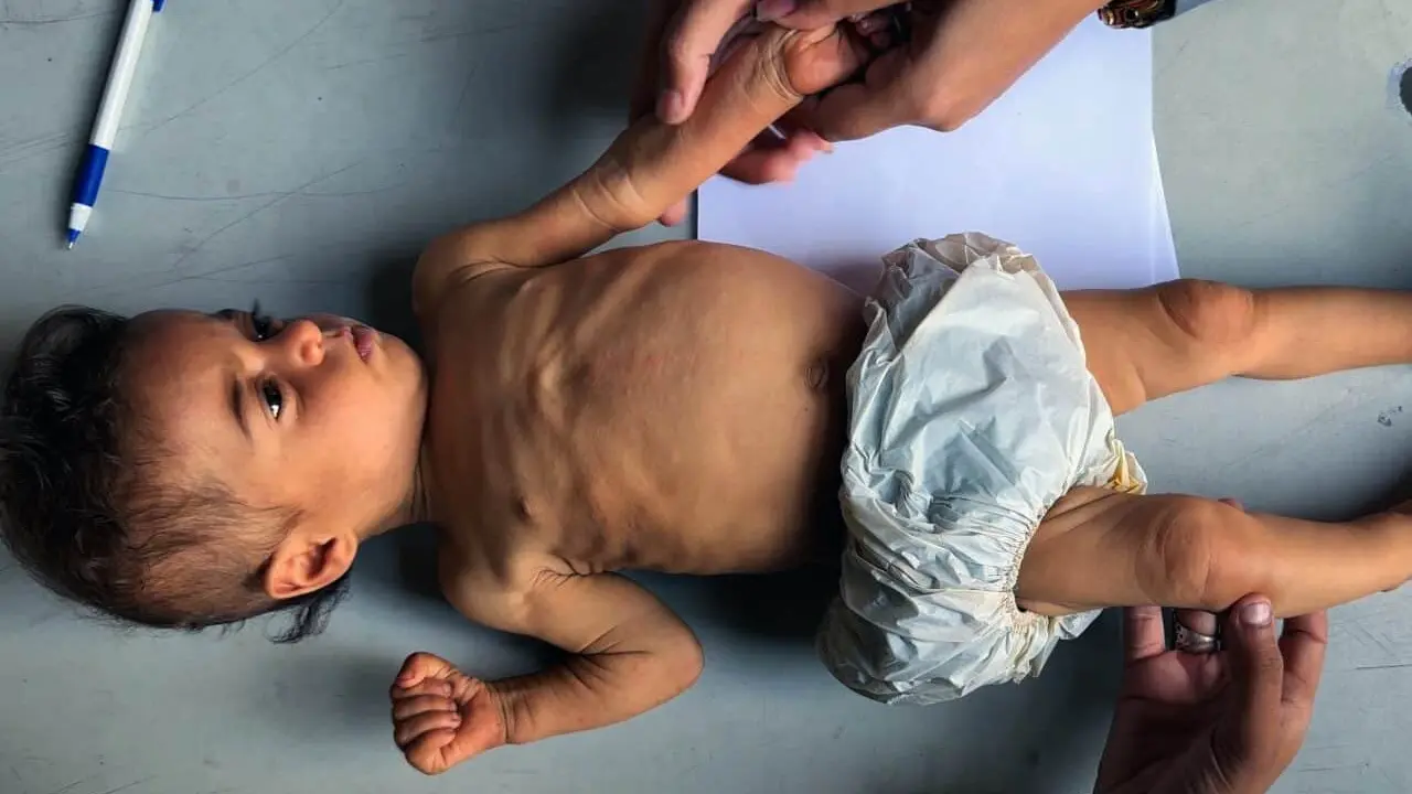 Personal sanitario de la UNRWA examina y trata a ni&ntilde;os que sufren malnutrici&oacute;n aguda grave en un centro m&eacute;dico de la UNRWA, ubicado en una escuela convertida en refugio en la ciudad de Gaza, el 17 de julio de 2025 - UNRWA / APA Images